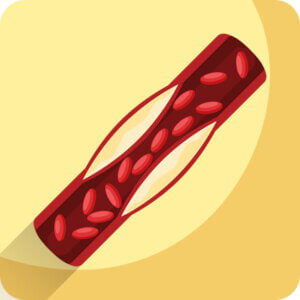 arteriosclerosis