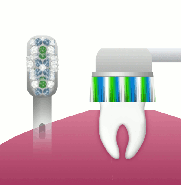 Sonic toothbrushes clean the teeth by high-frequency vibration of the brush head.
